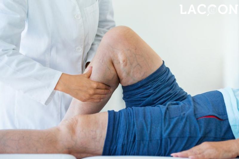 FAQs about what causes varicose veins