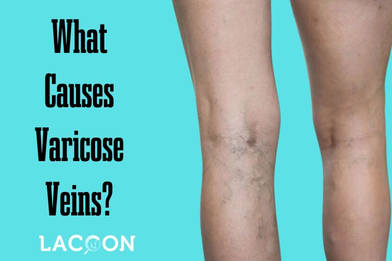 What Causes Varicose Veins Understanding the Factors and Risk Factors Involved